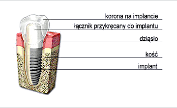 Implanty Gliwice